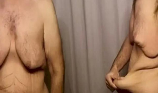 Obezite ameliyatlarından sonra oluşan deri sarkması tedavi edilebilir mi?