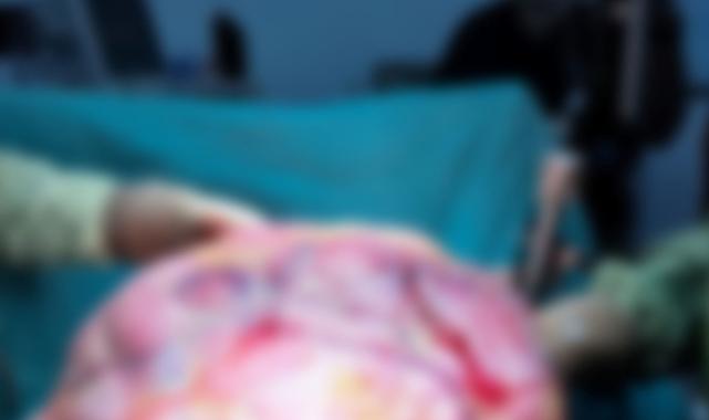 Trabzon'da 26 kiloluk tümörü çıkaran doktor konuştu