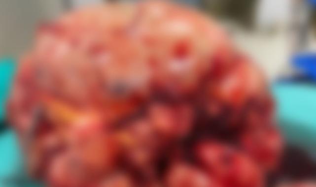 Trabzon'da 26 kiloluk tümörü çıkaran doktor konuştu