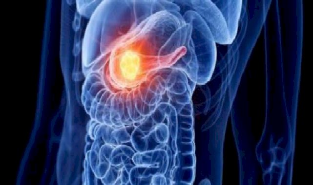 Pankreas Kanseri Tedavisinde Yenilikçi Yaklaşım