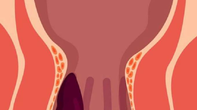 Uzun Süren Kabızlık Hemoroid Yapar mı ?