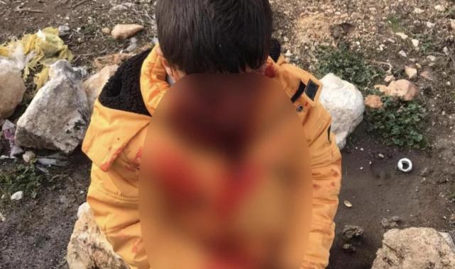 Adıyaman'da çocuğa saldıran başıboş köpek kuduz çıktı