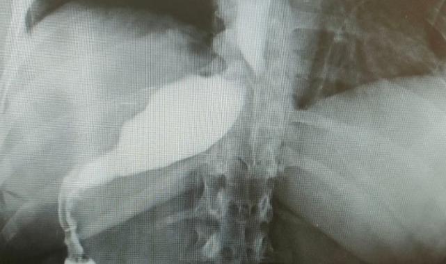 Antalya'da tüp mide ameliyatı oldu! Alman turistin midesi ters tarafta çıktı