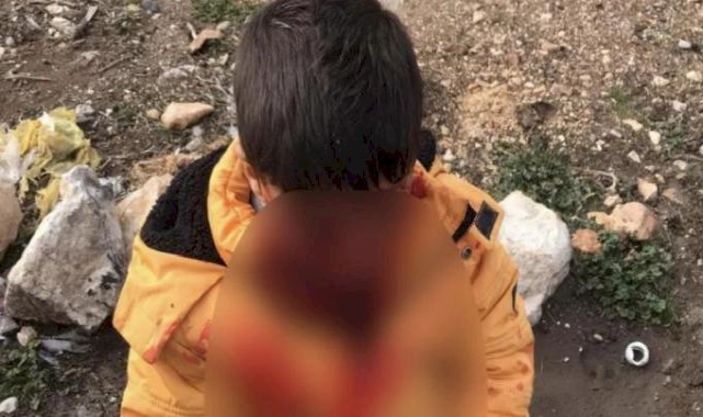 Adıyaman'da çocuğa saldıran başıboş köpek kuduz çıktı