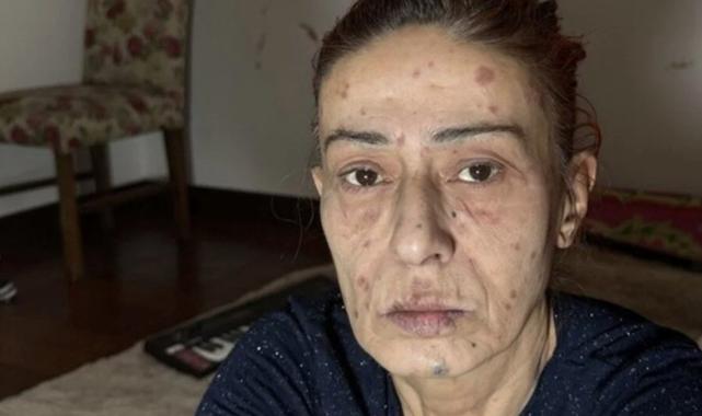 Boya yüzünden yüzü yanmıştı! Yıldız Tilbe'den yeni açıklama geldi