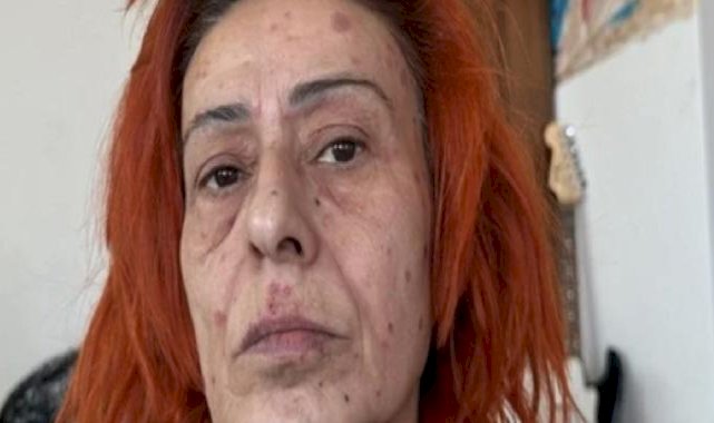 Boya yüzünden yüzü yanmıştı! Yıldız Tilbe'den yeni açıklama geldi