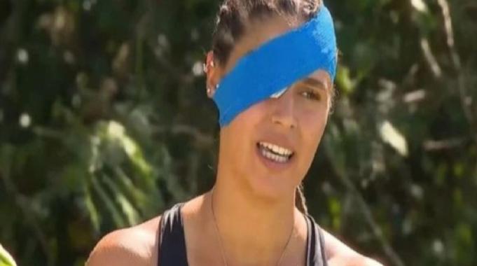 Yüzü gözü yanmıştı; Survivor Ayşe'ye ikinci darbe! Yarışmadan ayrılabilir...