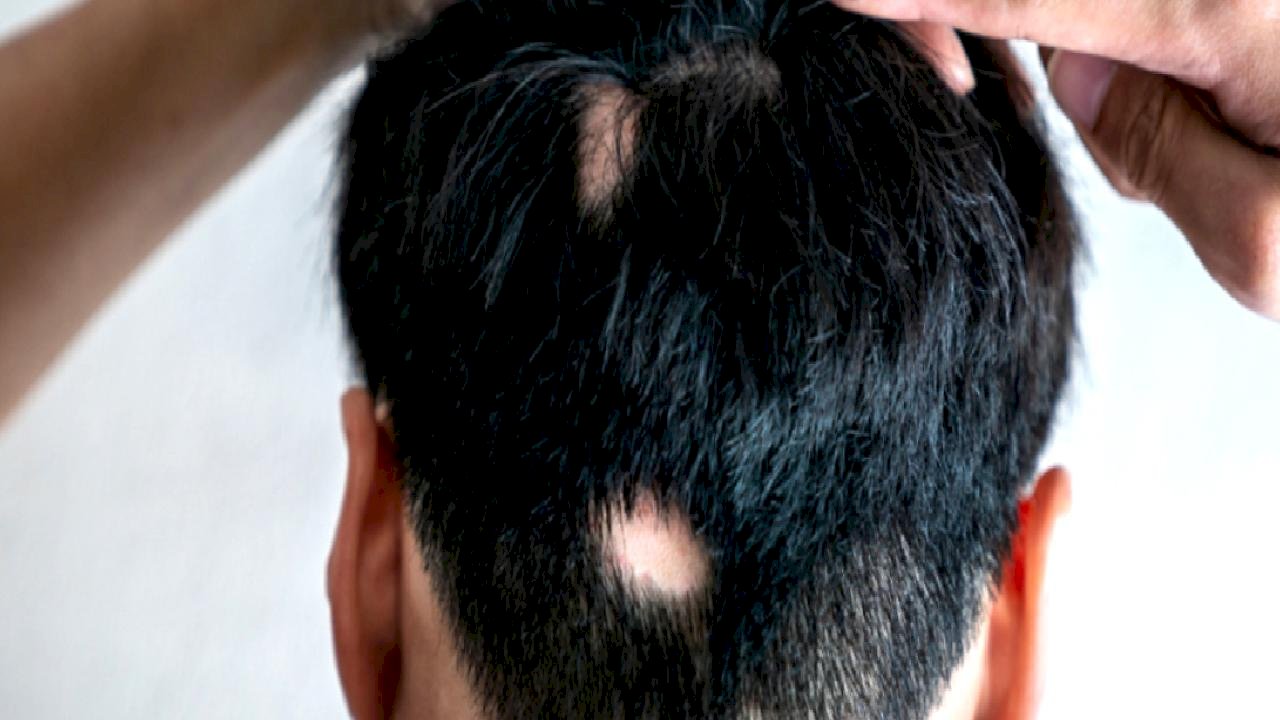 Yoğun stres erkeklerde saçkırana neden oluyor