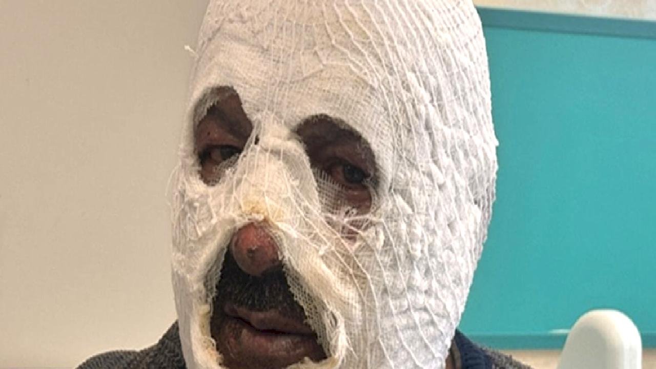 Erzincan'da kalorifer yakmak isterken kendini yaktı