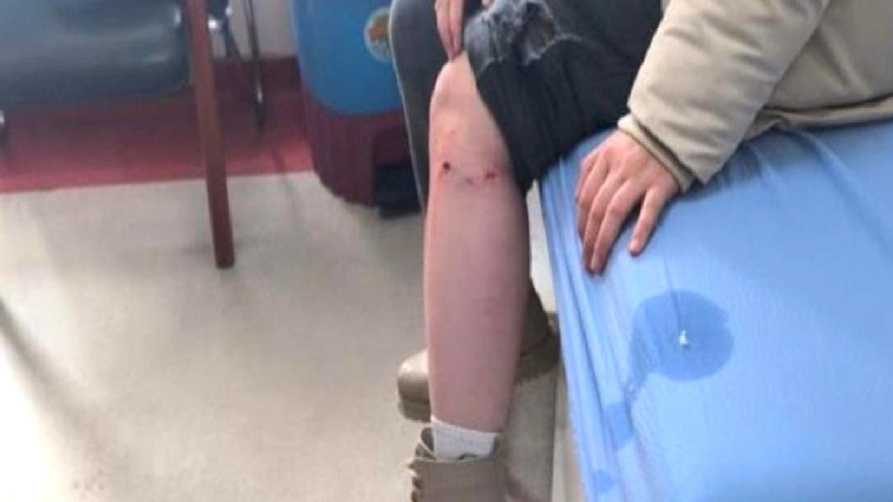 Kayseri'de sokak köpeğinin saldırdığı çocuk yaralandı