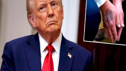 Trump elindeki morlukların nedenini ilk kez açıkladı