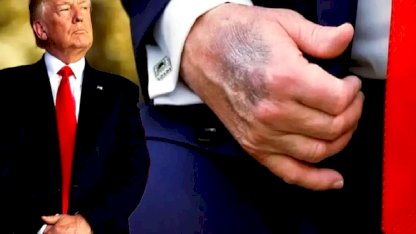 Trump'ın Morarmış Eli: Masaya Çarptım, Aspirin Kullanıyorum