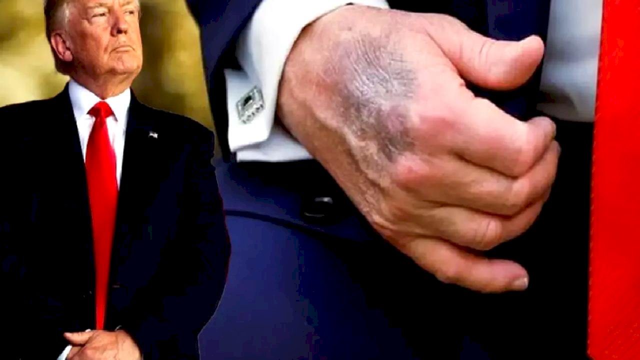 Trump'ın Morarmış Eli: Masaya Çarptım, Aspirin Kullanıyorum