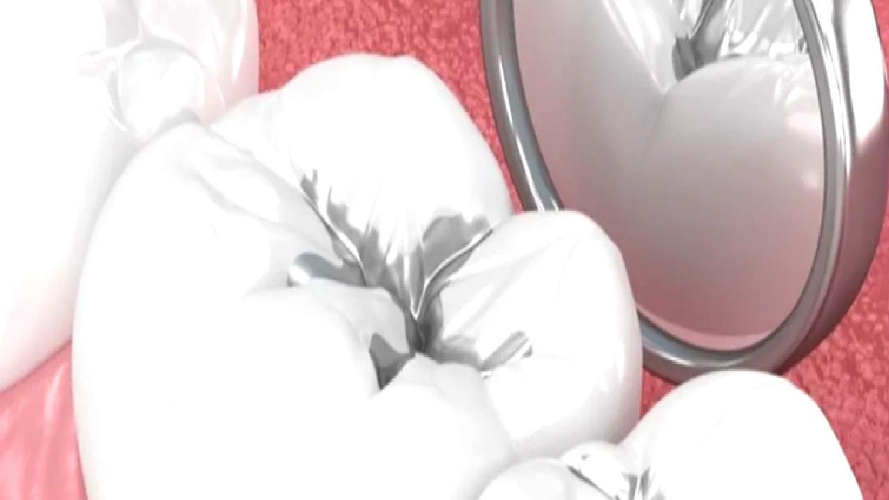 Amalgam Dolgular Değiştirilmeli mi?