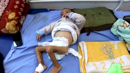 Gazze'de Çocuklar Yetersiz Beslenmeyle Mücadele Ediyor
