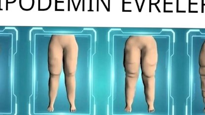 Su İçsem Yarıyor Diyorsanız Lipödem Olabilirsiniz
