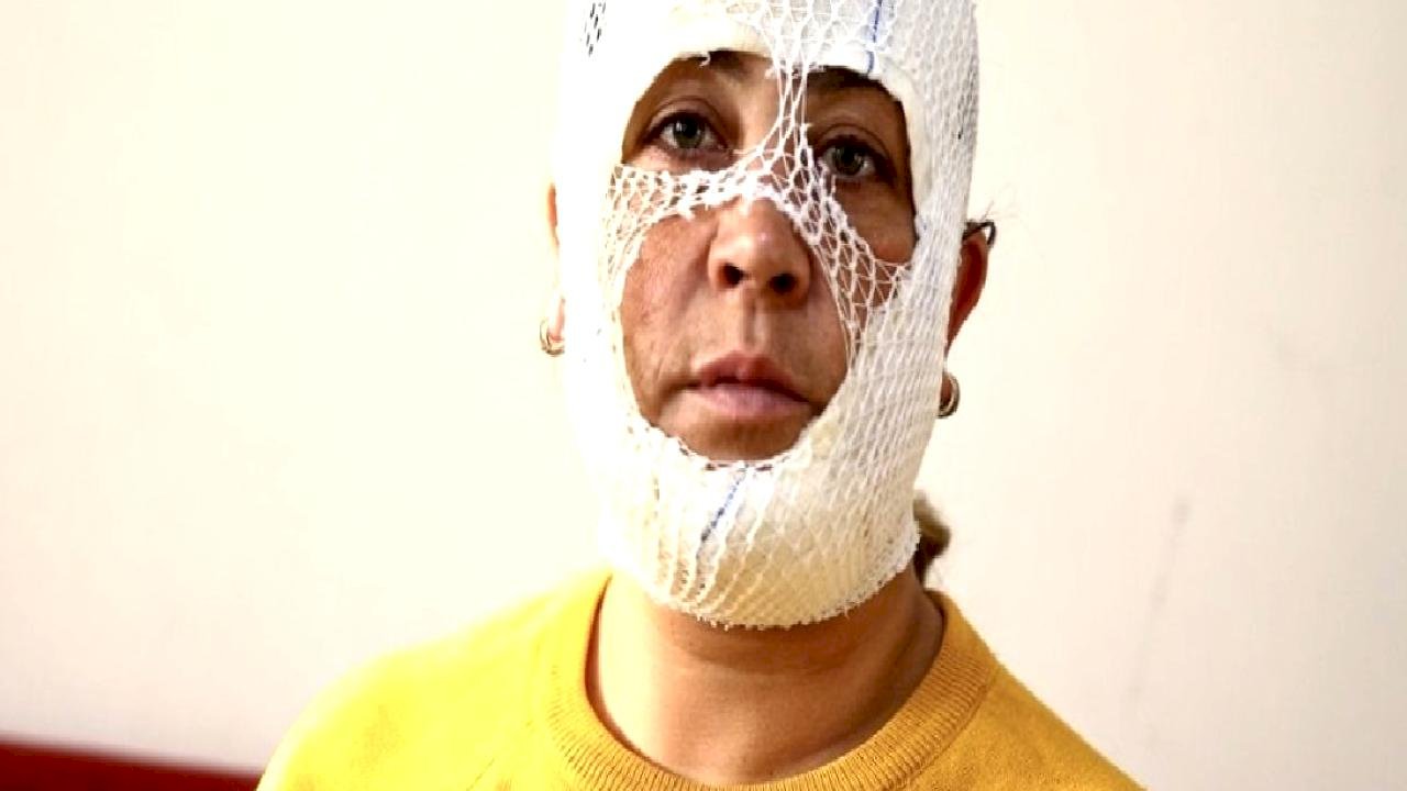 Adana'da cilt bakımı sonrası yüzünde yanık oluştu: İşletmeden şikayetçi oldu