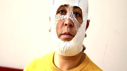 Adana'da cilt bakımı sonrası yüzünde yanık oluştu: İşletmeden şikayetçi oldu