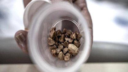 Erzurum'da bir kadının idrar kanalından 51 taş çıkarıldı