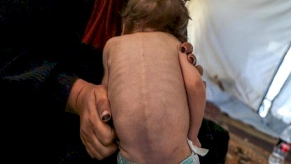 Gazze'de çocuklar hem açlık hem de hastalıkla mücadele ediyor